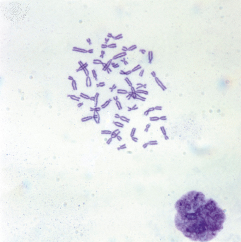 A cluster of purple-dyed human chromosomes under a microscope 